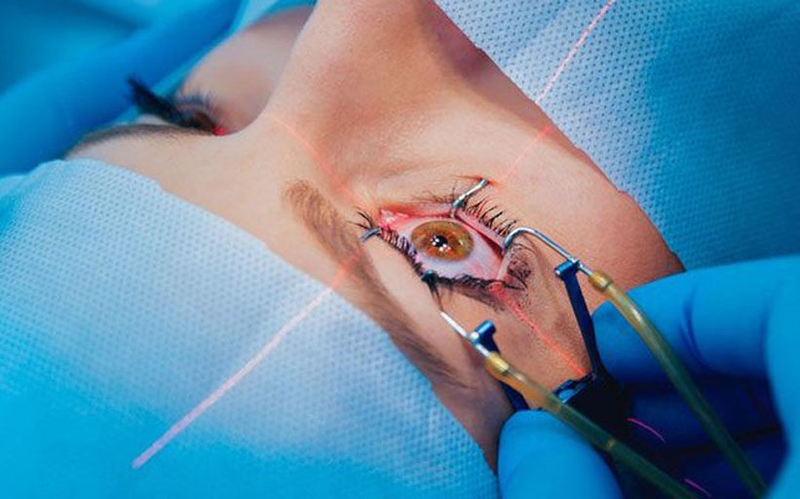 Loạn thị có mổ được không?