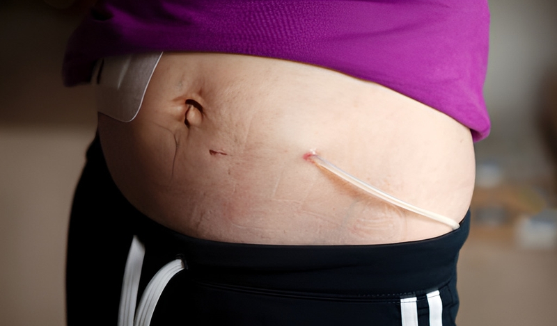 Lọc màng bụng trong suy thận: Phương pháp điều trị hiệu quả và tiện lợi 1