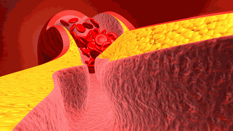 Lọc mỡ máu và những thông tin cần biết 1