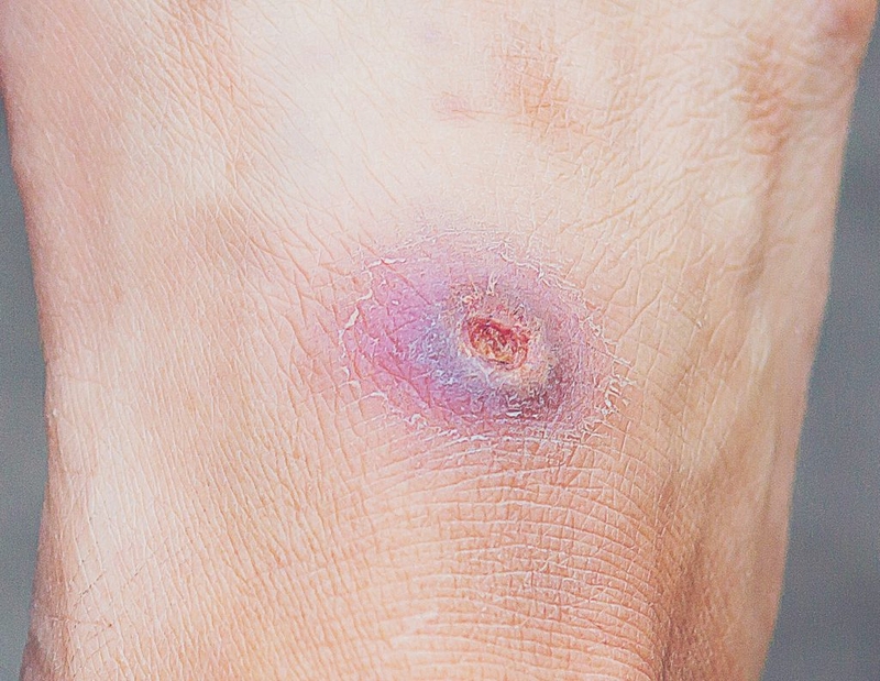 Loét do tì đè là gì? Hướng điều trị và chăm sóc người bệnh - 1