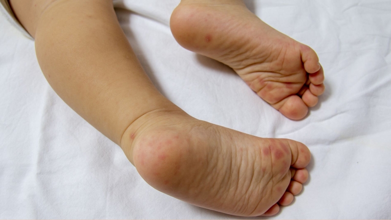 Tay chân miệng là bệnh truyền nhiễm nguy hiểm thường gặp ở trẻ nhỏ