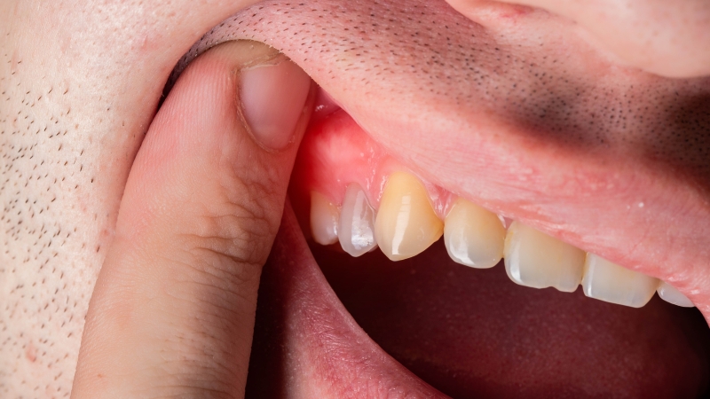 Lợi đang sưng có nhổ răng khôn được không?