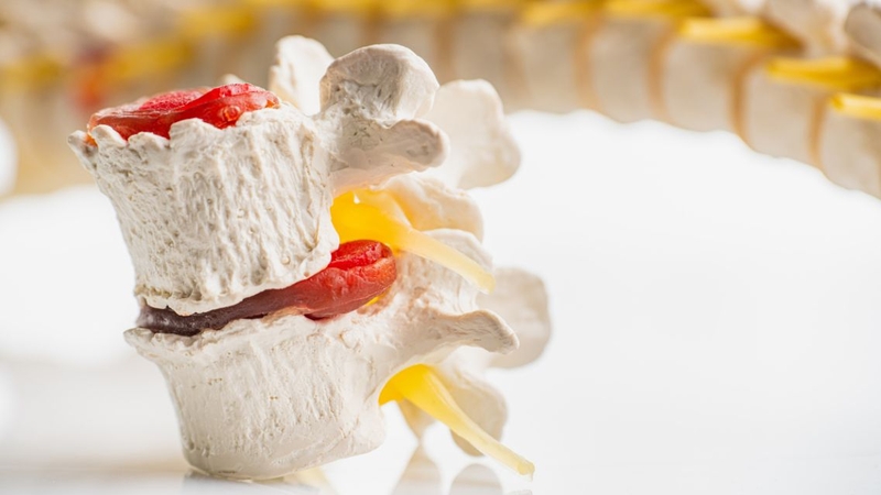 Lồi đĩa đệm có nguy hiểm không? Nguyên nhân, triệu chứng, cách điều trị 1