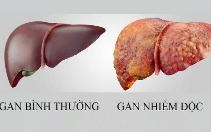 Gan nhiễm độc sẽ suy giảm chức năng thanh lọc, gây ra một số bệnh lý nguy hiểm cho cơ thể