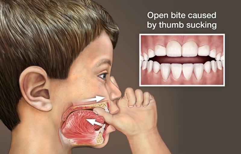 Lợi ích và rủi ro của phẫu thuật hàm hô 2