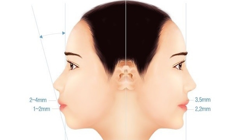 Lợi ích và rủi ro của phẫu thuật hàm hô 4