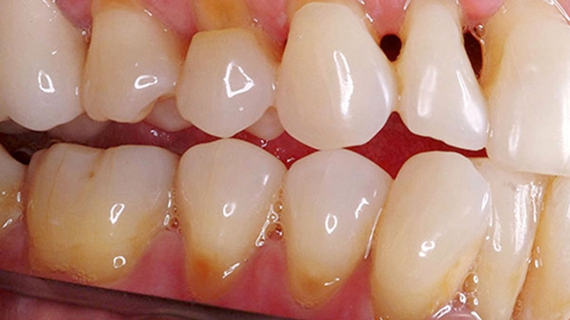 Lợi không bám vào chân răng có sao không? 2