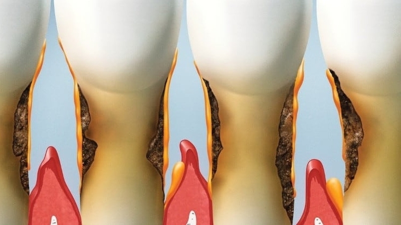 Lợi không bám vào chân răng có sao không? 1