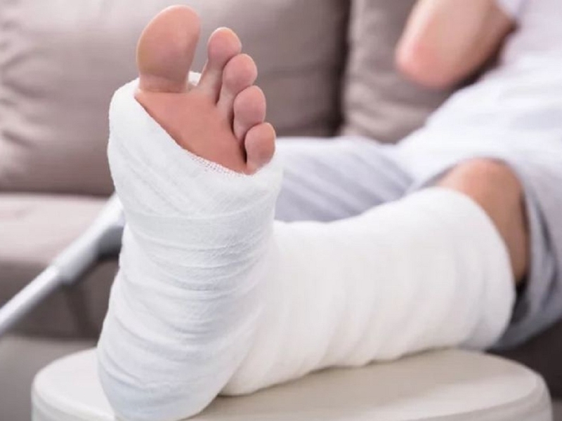 Lời khuyên cho bệnh nhân bị gãy xương chân 1