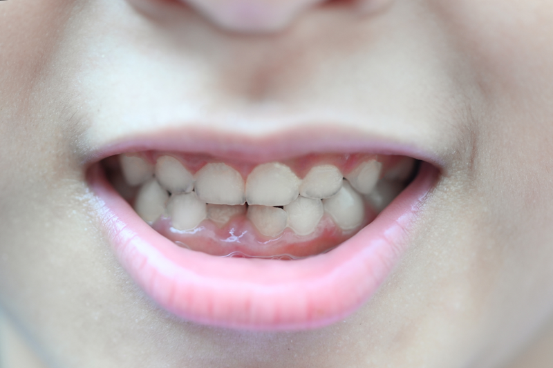 Lợi trùm răng cửa: Nguyên nhân, biểu hiện và hướng khắc phục hiệu quả 1