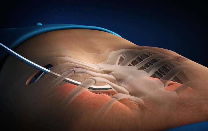 Lõm ngực có phải mổ không? 4