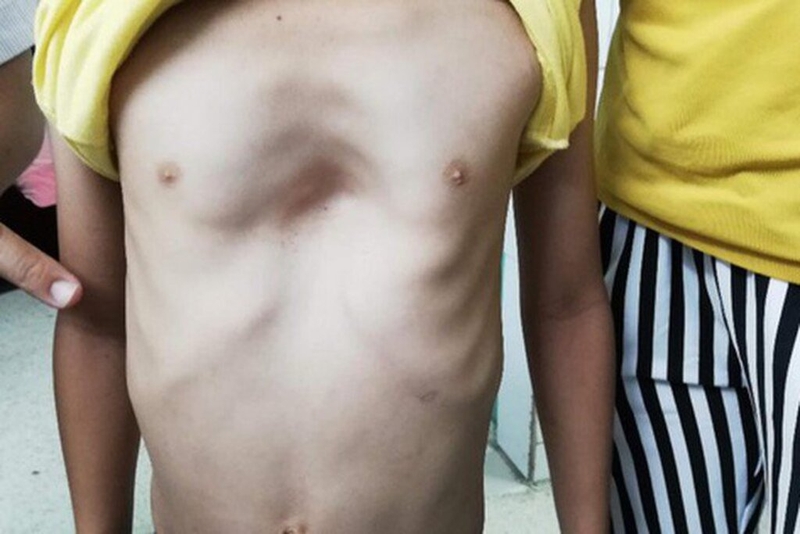 Lõm ngực ở trẻ em có nguy hiểm không? 1