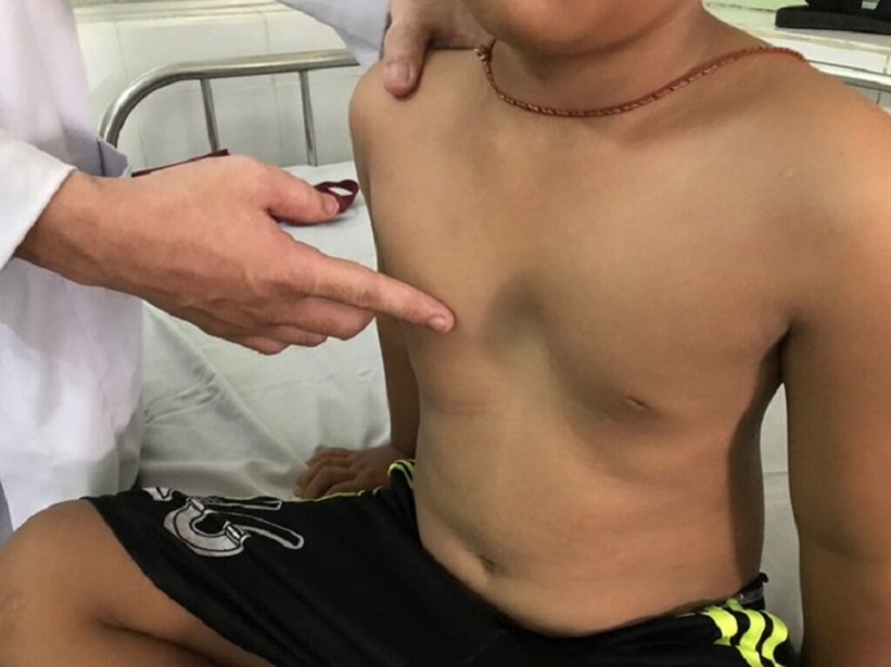 Lõm ngực ở trẻ em có nguy hiểm không? 2
