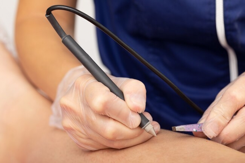 Làm thế nào để loại bỏ lông vĩnh viễn? 2