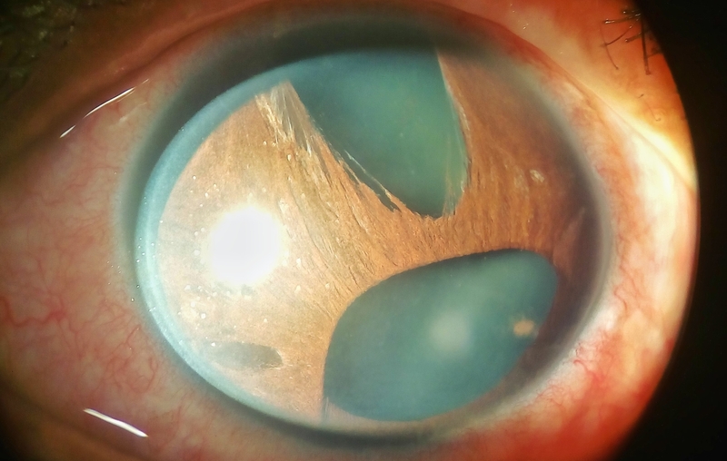 Lòng đen mắt gọi là gì? Vấn đề thường gặp với lòng đen mắt 3