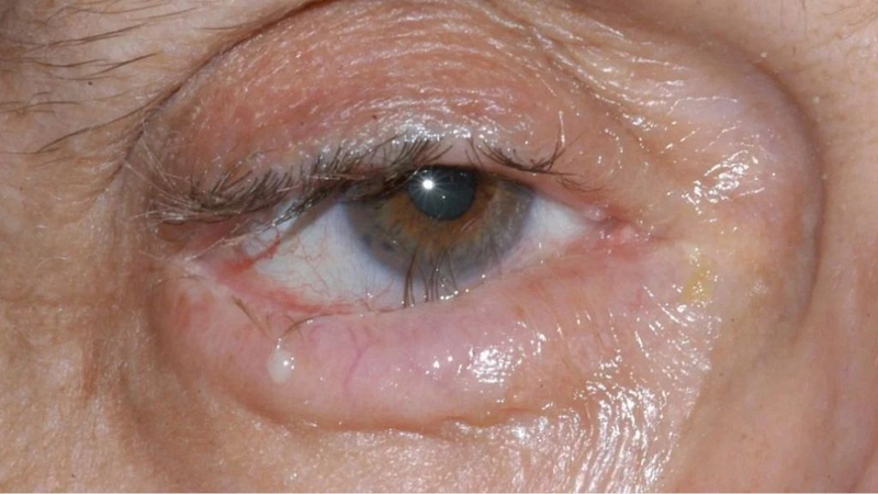 Lông mi mọc ngược và những điều cần biết 2