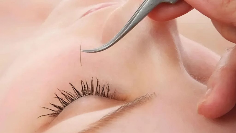 Lông mi mọc ngược và những điều cần biết 4