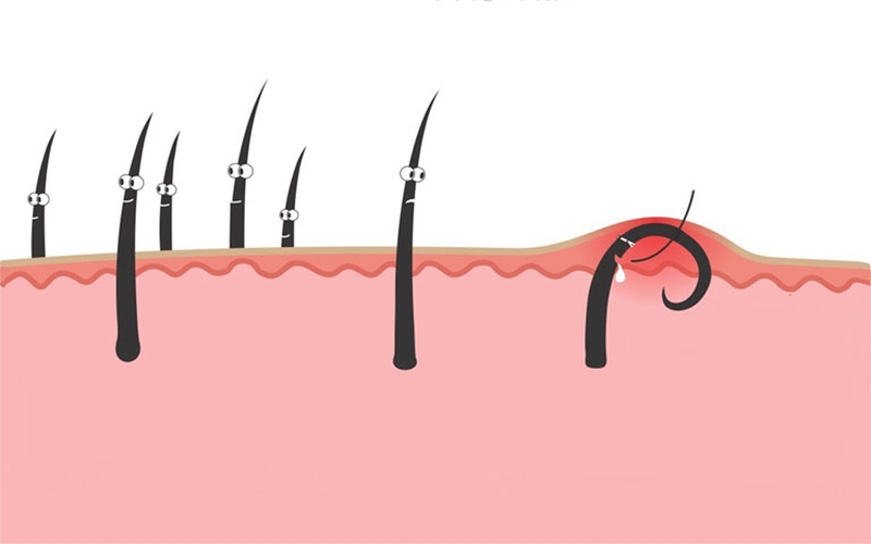 Lông mọc ngược là gì? Các trị lông mọc ngược hiệu quả 1