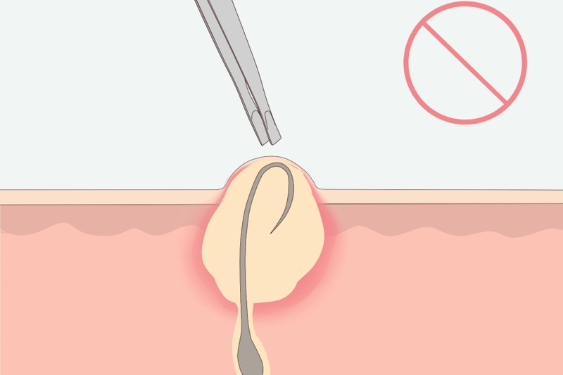 Lông mọc ngược là gì? Các trị lông mọc ngược hiệu quả 3
