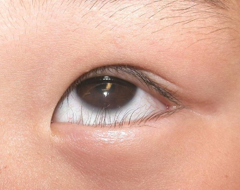 phau thuat long quam kieng an gi 1