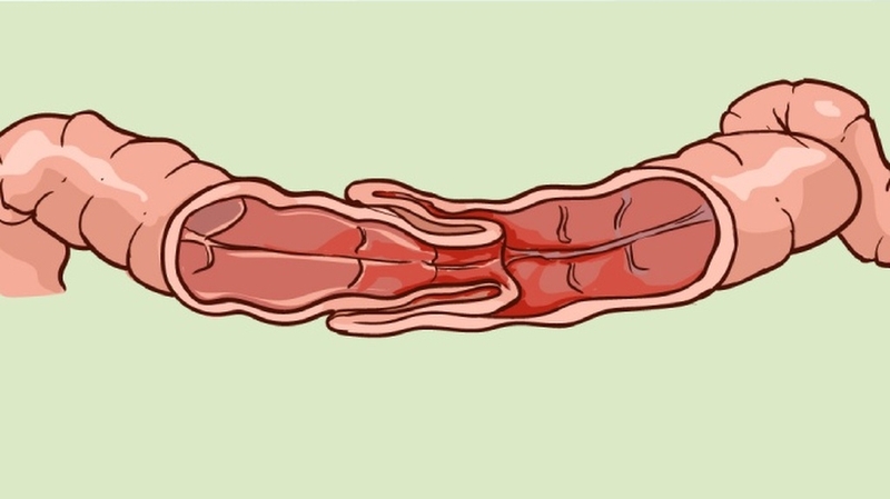 Lồng ruột ở trẻ em: Dấu hiệu nhận biết và cách xử lý 4