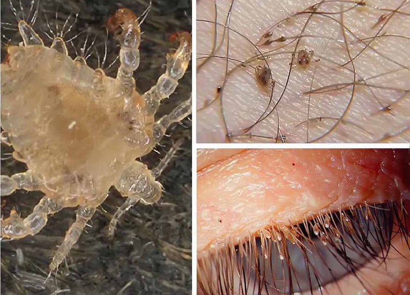 Lông vùng kín bị bạc trắng: Nguyên nhân và cách khắc phục 3