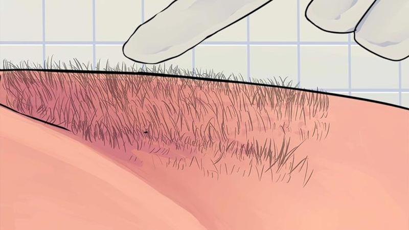 Lông vùng kín bị rụng: Nguyên nhân và cách điều trị 3