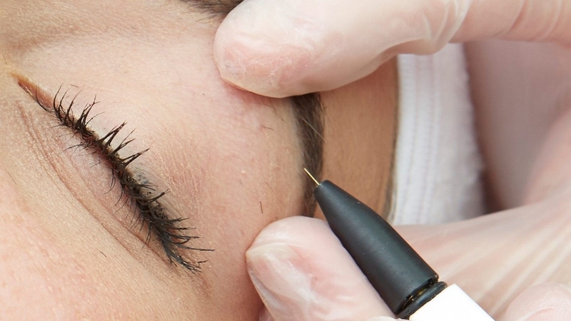 Mắt thường bị đỏ do lông mi chọc vào mắt 4