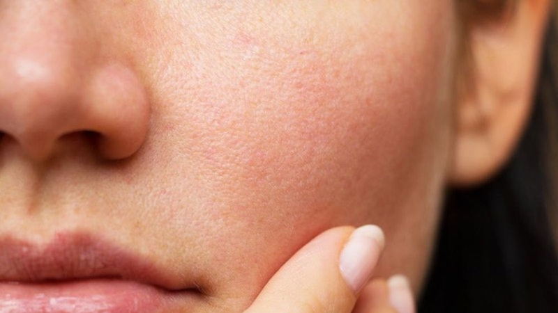 Da khô thiếu ẩm dễ bị mốc nền khi trang điểm