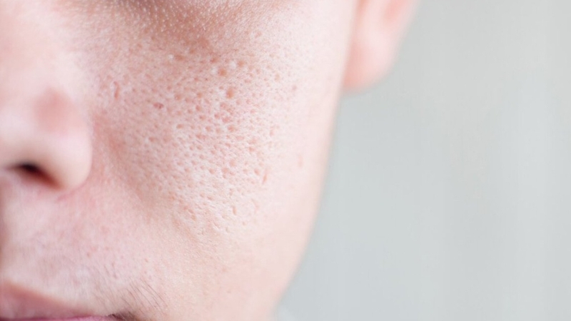 Lột mụn làm lỗ chân lông to – Những điều bạn cần biết - Hình 1