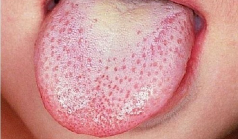 Nấm miệng - nguyên nhân khiến lưỡi đóng bợn trắng