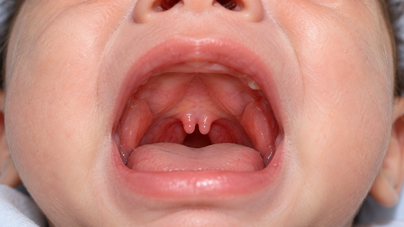 Lưỡi gà chẻ đôi là một dị tật bẩm sinh xảy ra khi cấu trúc lưỡi gà ở phía sau khoang miệng không liền khối mà bị tách thành hai thùy riêng biệt