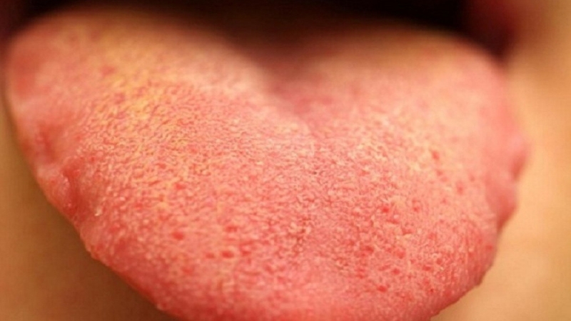 Lưỡi nổi hạt đỏ cảnh báo sức khỏe răng miệng -1