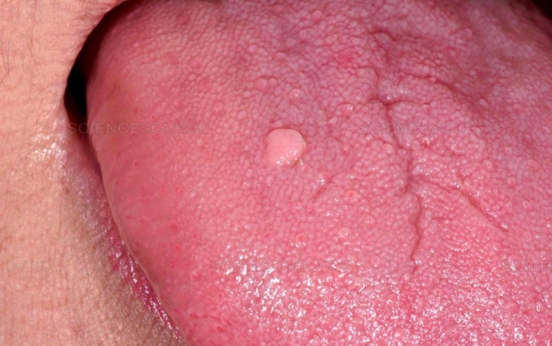 Lưỡi nổi hạt đỏ cảnh báo sức khỏe răng miệng -2