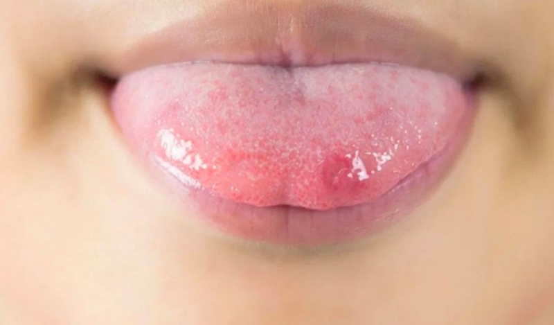 Lưỡi nổi mụn thịt cảnh báo bệnh gì? Có điều trị được không? 1