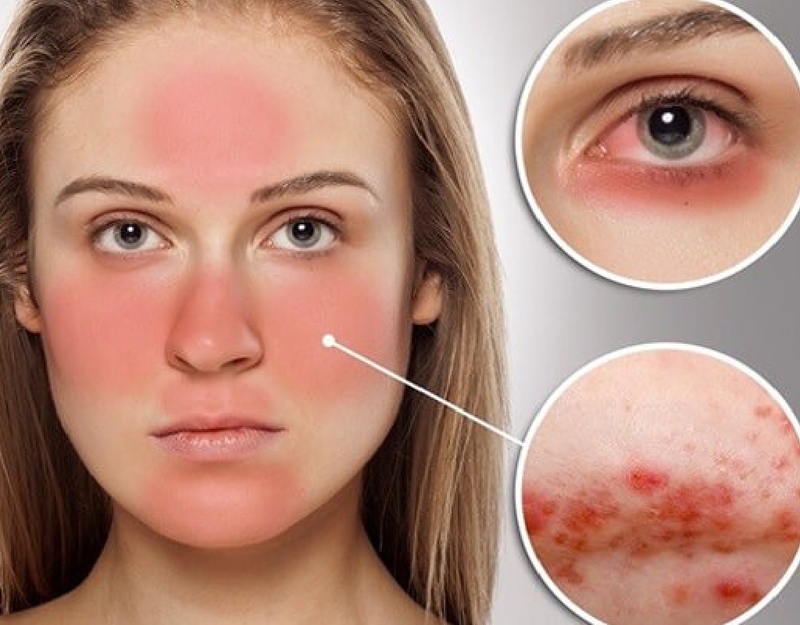 Lupus ban đỏ ảnh hướng đến mắt bạn như thế nào? 1