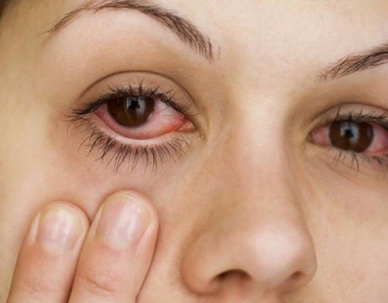 Lupus ban đỏ ảnh hướng đến mắt bạn như thế nào? 3