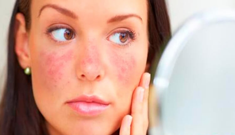 Lupus ban đỏ bán cấp và những điều cần lưu ý3