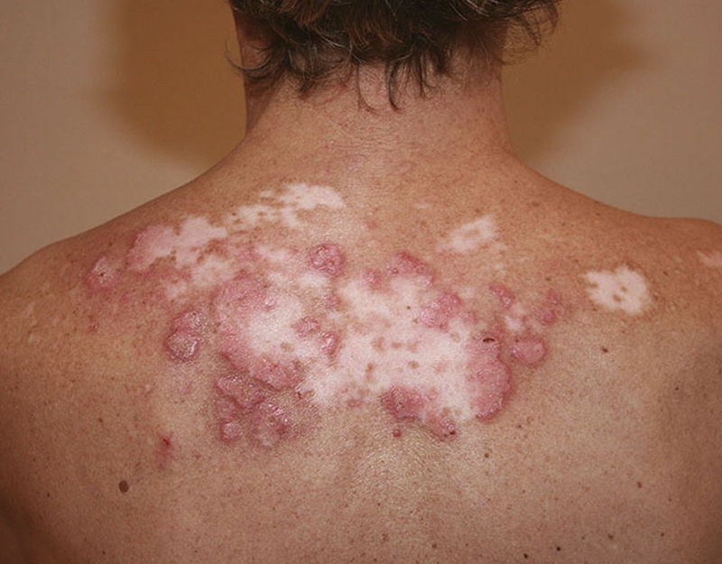 Lupus ban đỏ có gây đau khớp không? 1