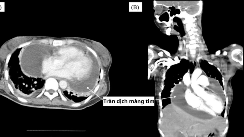 Lupus ban đỏ có gây tràn dịch màng tim không là băn khoăn của nhiều người bệnh