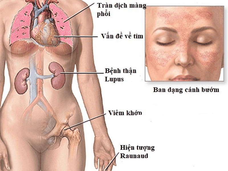 Lupus ban đỏ có mấy loại? Biến chứng của lupus ban đỏ nguy hiểm như thế nào? 2