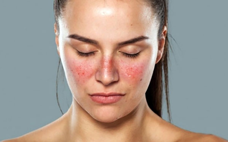 lupus ban đỏ có sinh con được không 1