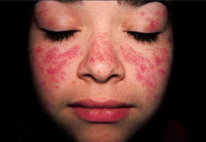 Lupus ban đỏ dạng đĩa có ngứa không? 2