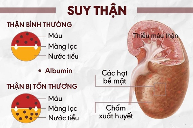 Lupus ban đỏ hệ thống giai đoạn cuối nguy hiểm như thế nào? 2