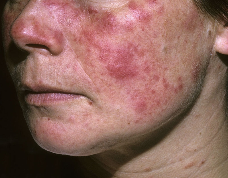 Lupus ban đỏ hệ thống: Nguyên nhân và cách điều trị 1