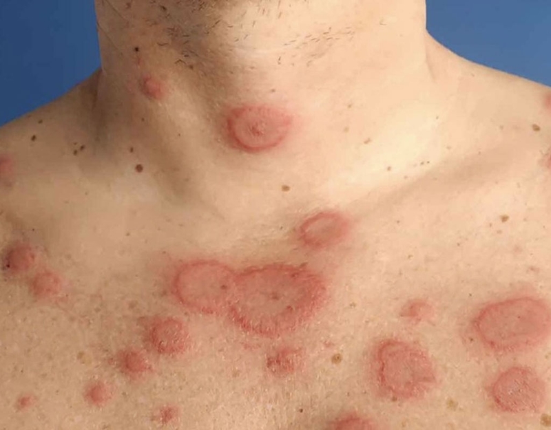 Lupus ban đỏ là gì? Lupus ban đỏ nên khám ở đâu? 1