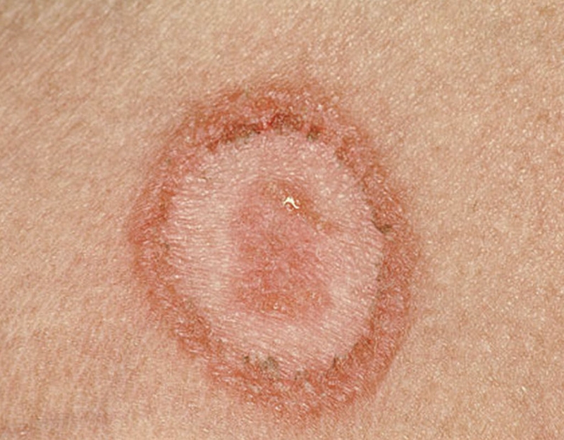 Lupus ban đỏ là gì? Lupus ban đỏ nên khám ở đâu? 2