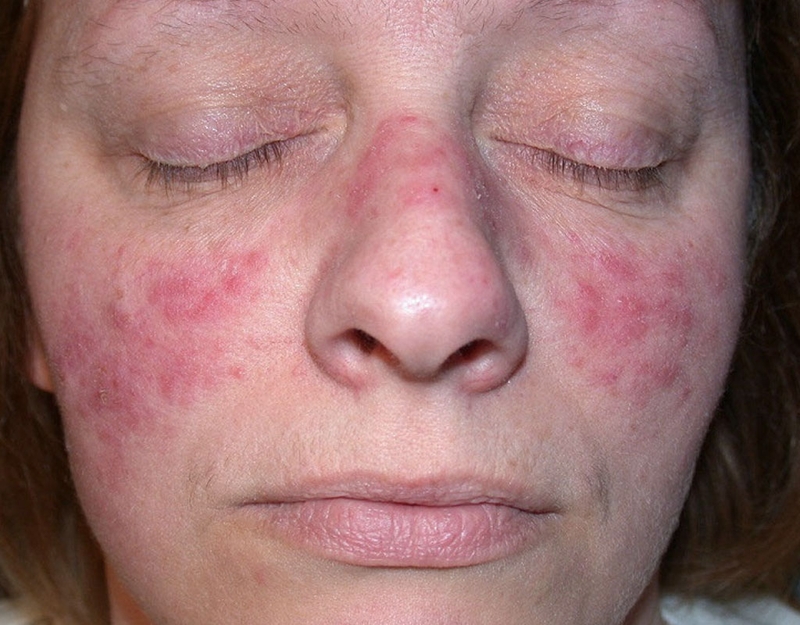 Lupus ban đỏ là gì? Lupus ban đỏ nên khám ở đâu? 3