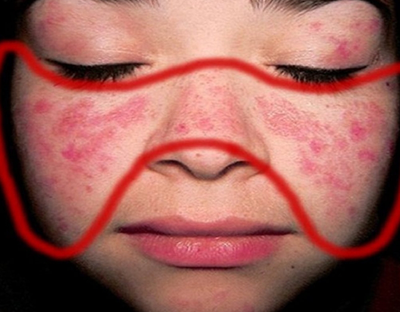 Lupus ban đỏ mãn tính: Nguyên nhân, triệu chứng và cách điều trị 1