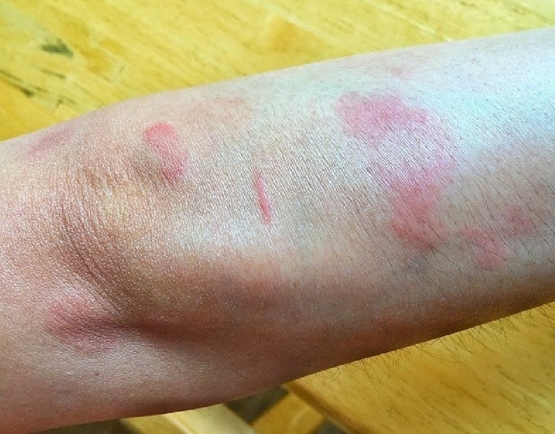 Lupus ban đỏ mãn tính: Nguyên nhân, triệu chứng và cách điều trị 2